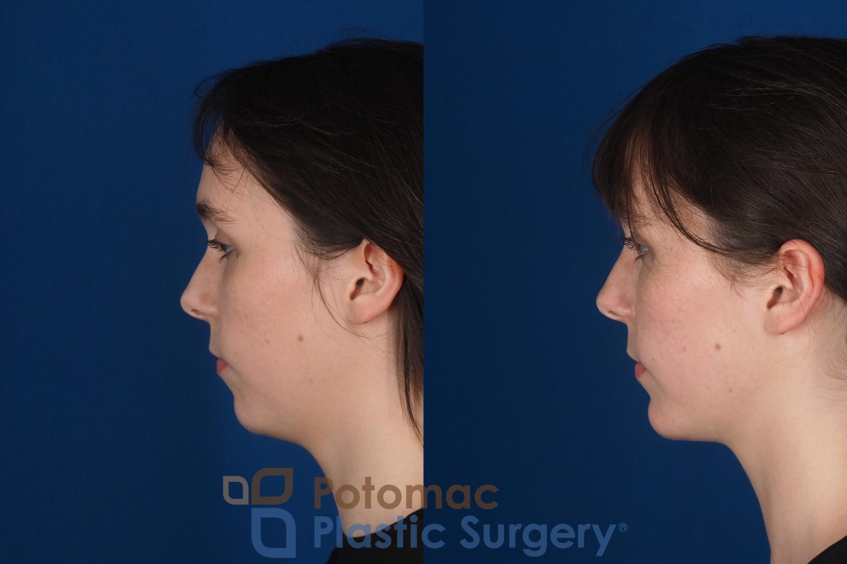Before & After Facial Sculpting Case 344 Left Side View in Washington DC & Arlington , DC