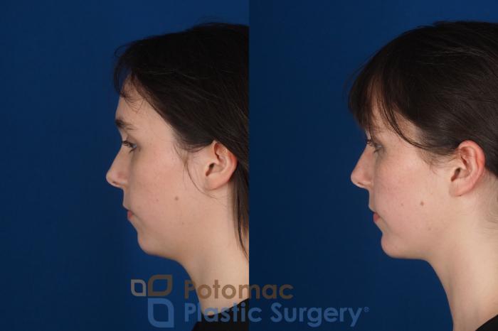 Before & After Chin Augmentation Case 344 Left Side View in Washington DC & Arlington , DC