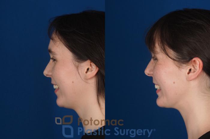 Before & After Chin Augmentation Case 344 Left - Smiling View in Washington DC & Arlington , DC