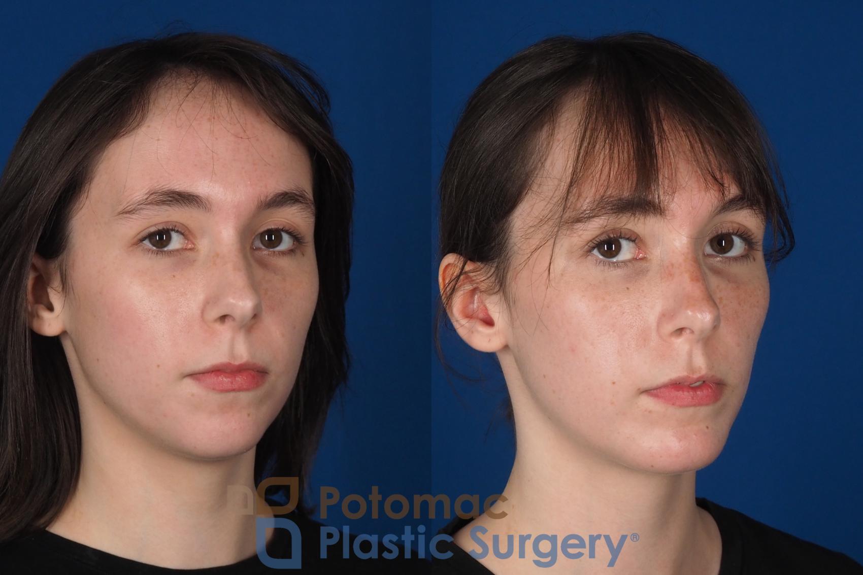 Before & After Facial Sculpting Case 344 Right Oblique 2 View in Washington DC & Arlington , DC