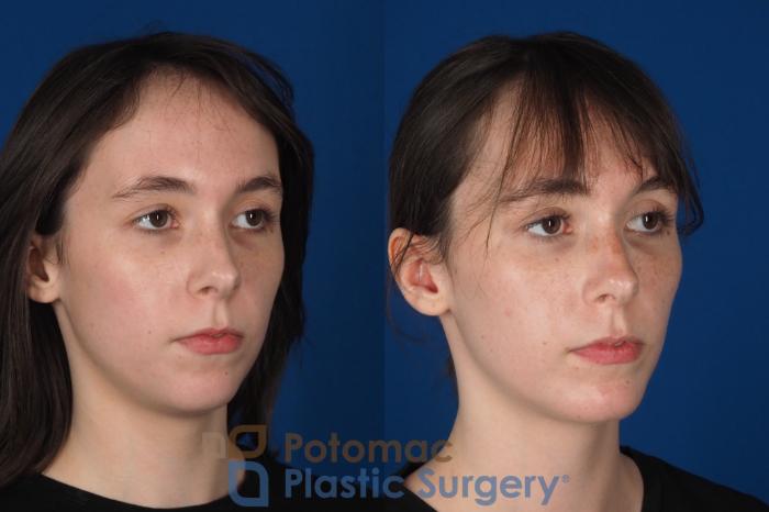 Before & After Chin Augmentation Case 344 Right Oblique View in Washington DC & Arlington , DC
