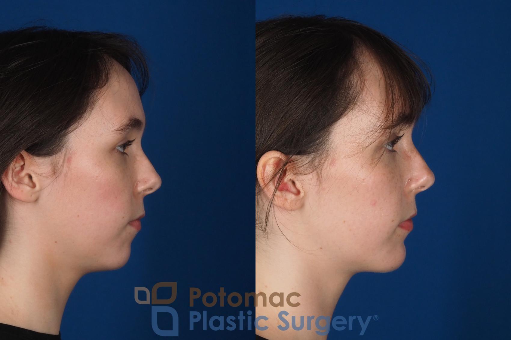 Before & After Chin Augmentation Case 344 Right Side View in Washington DC & Arlington , DC