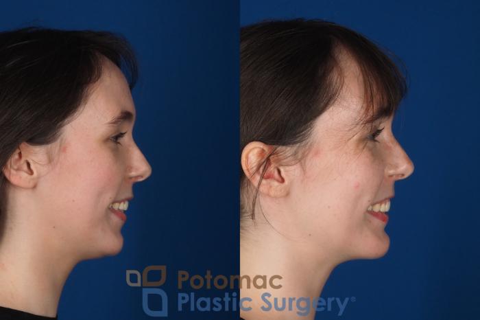 Before & After Chin Augmentation Case 344 Right - Smiling View in Washington DC & Arlington , DC