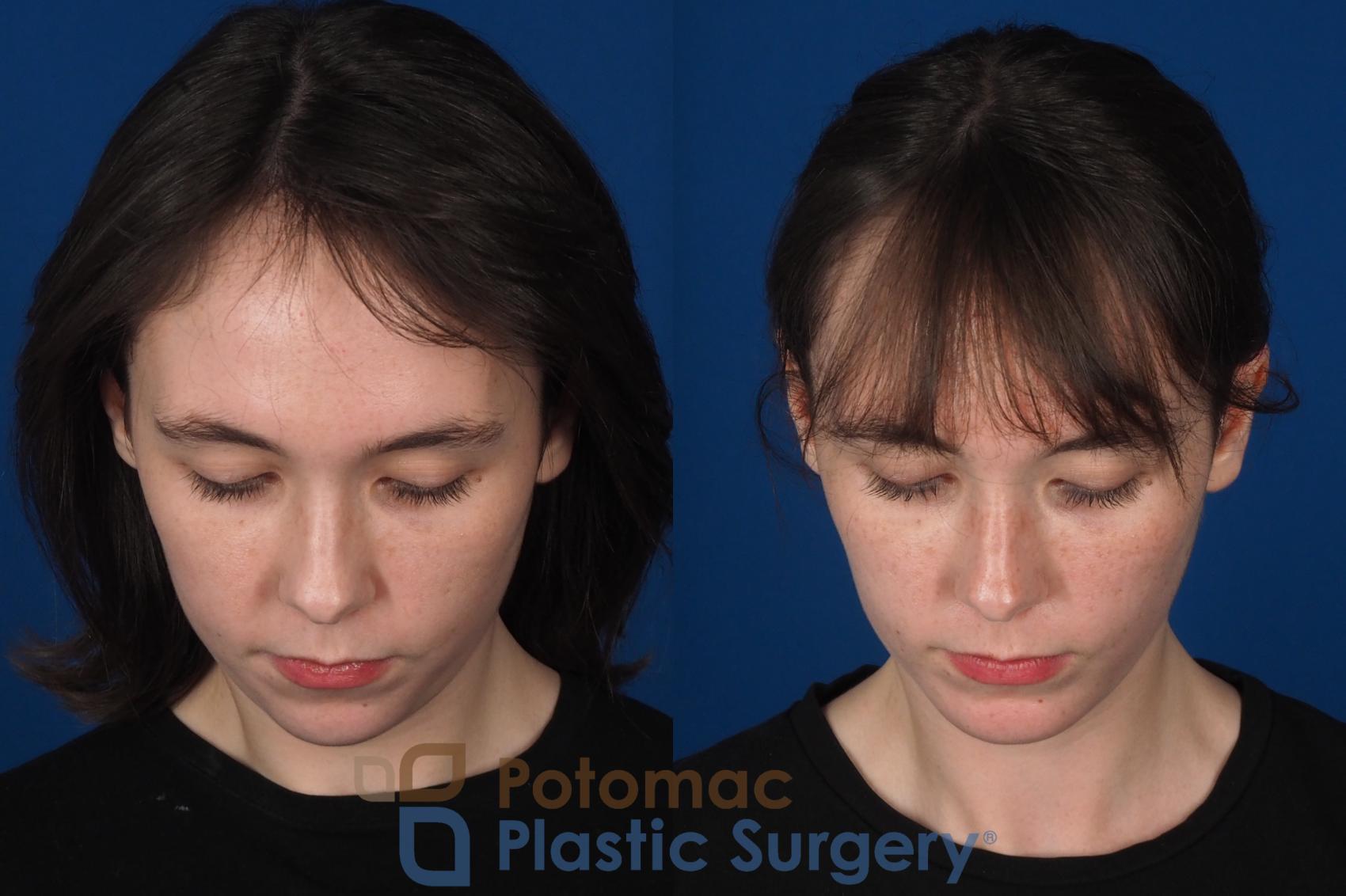 Before & After Facial Sculpting Case 344 Top View in Washington DC & Arlington , DC