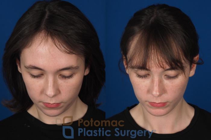Before & After Chin Augmentation Case 344 Top View in Washington DC & Arlington , DC