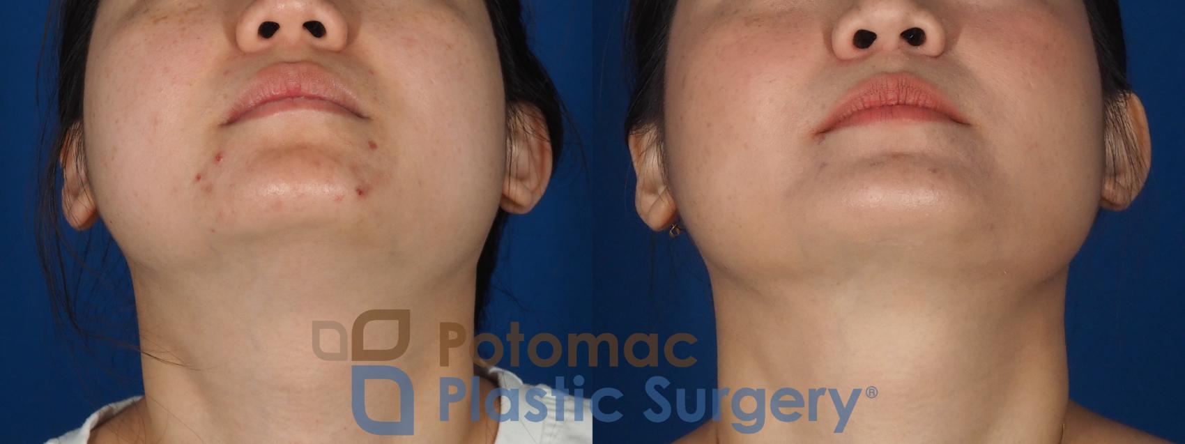 Before & After Facial Sculpting Case 359 Bottom View in Washington DC & Arlington , DC