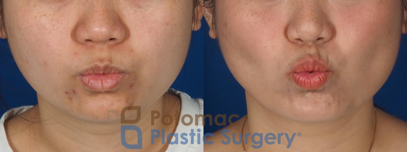 Before & After Facial Sculpting Case 359 Front - Puckering View in Washington DC & Arlington , DC