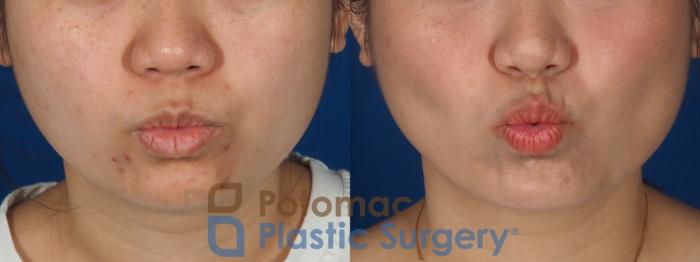 Before & After Facial Sculpting Case 359 Front - Puckering View in Washington DC & Arlington , DC
