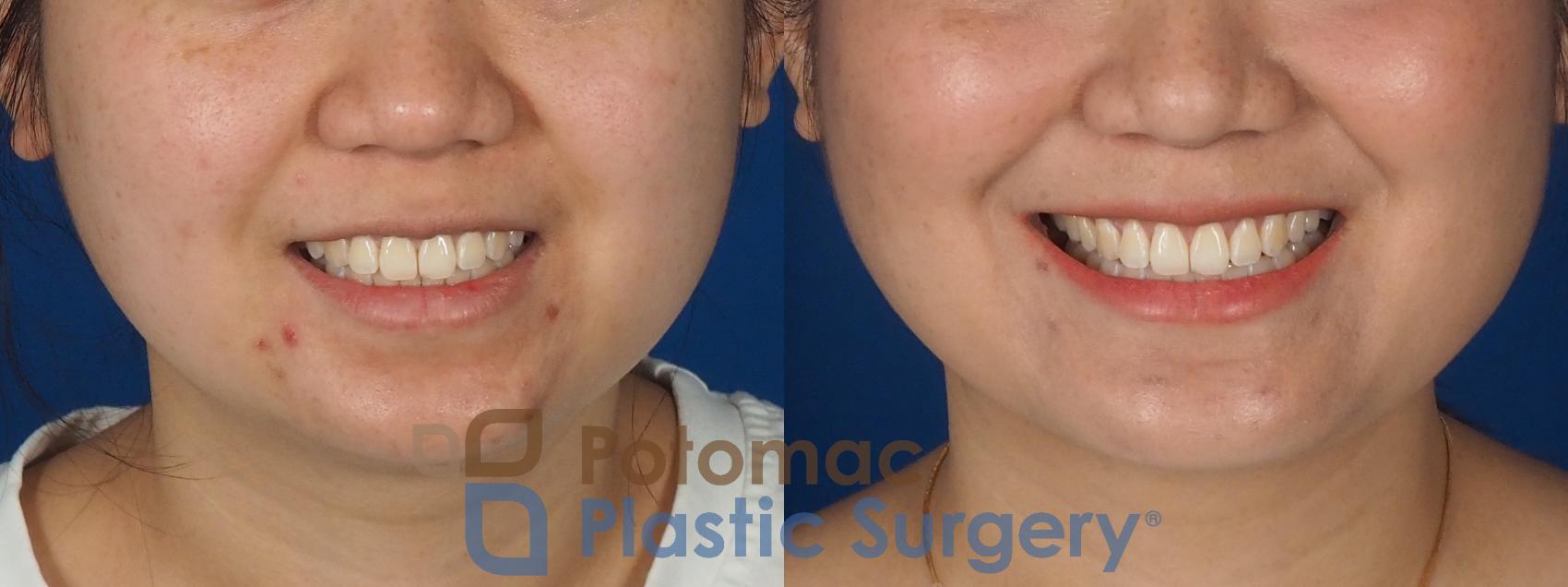 Before & After Facial Sculpting Case 359 Front - Smiling View in Washington DC & Arlington , DC