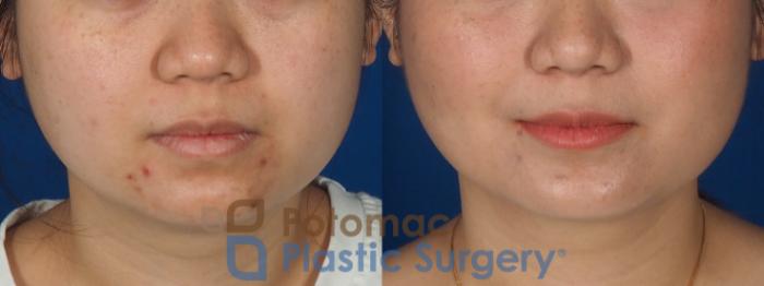 Before & After Facial Sculpting Case 359 Front View in Washington DC & Arlington , DC