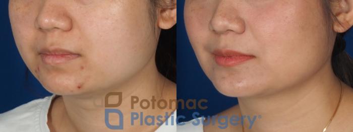 Before & After Facial Sculpting Case 359 Left Oblique View in Washington DC & Arlington , DC