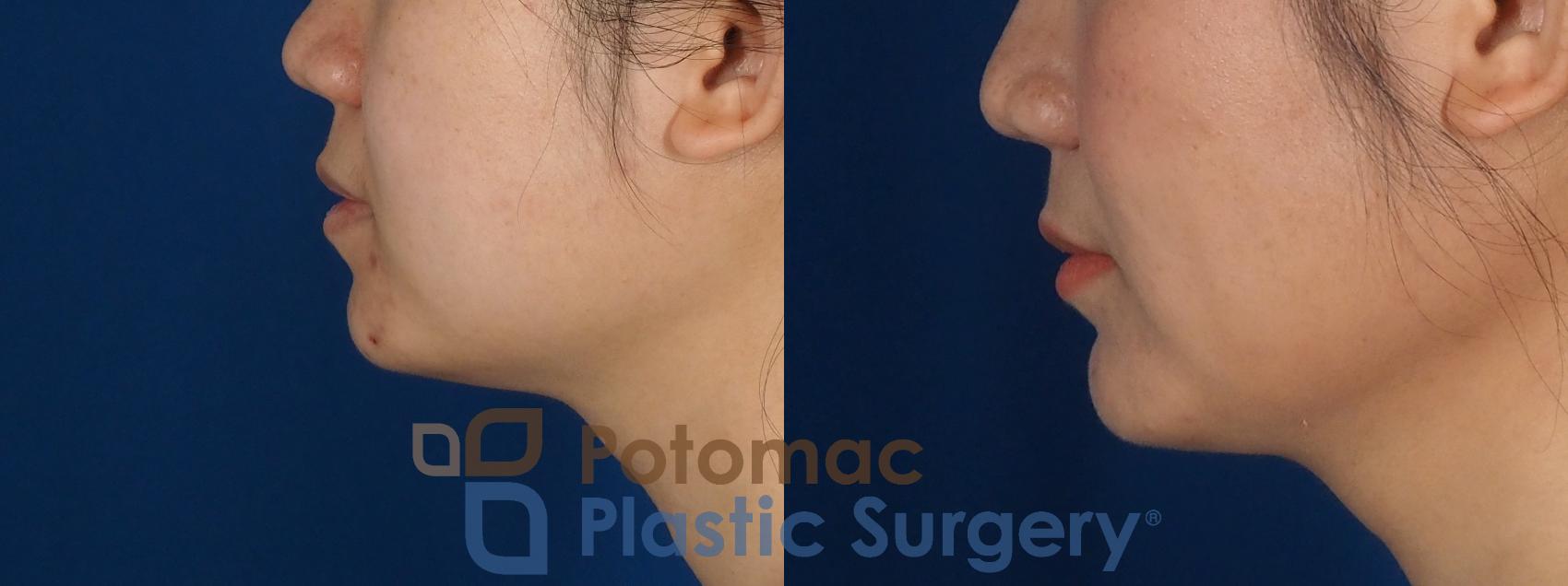 Before & After Facial Sculpting Case 359 Left Side View in Washington DC & Arlington , DC