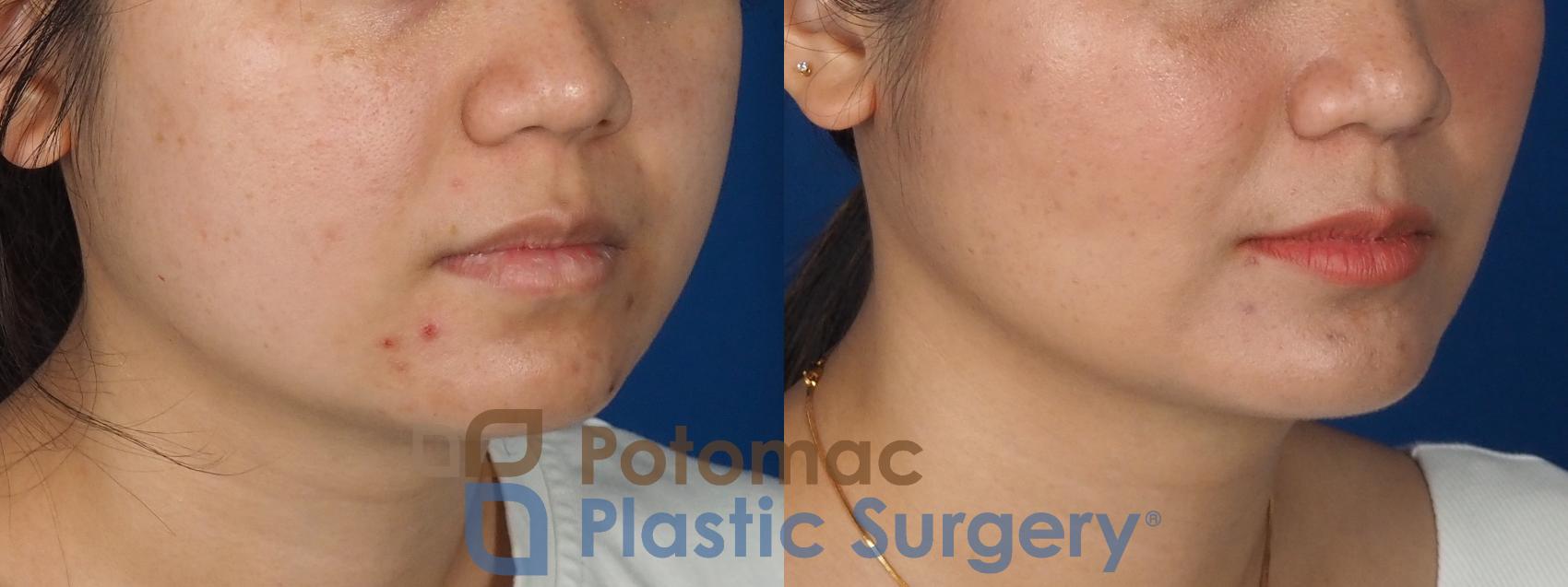 Before & After Facial Sculpting Case 359 Right Oblique View in Washington DC & Arlington , DC