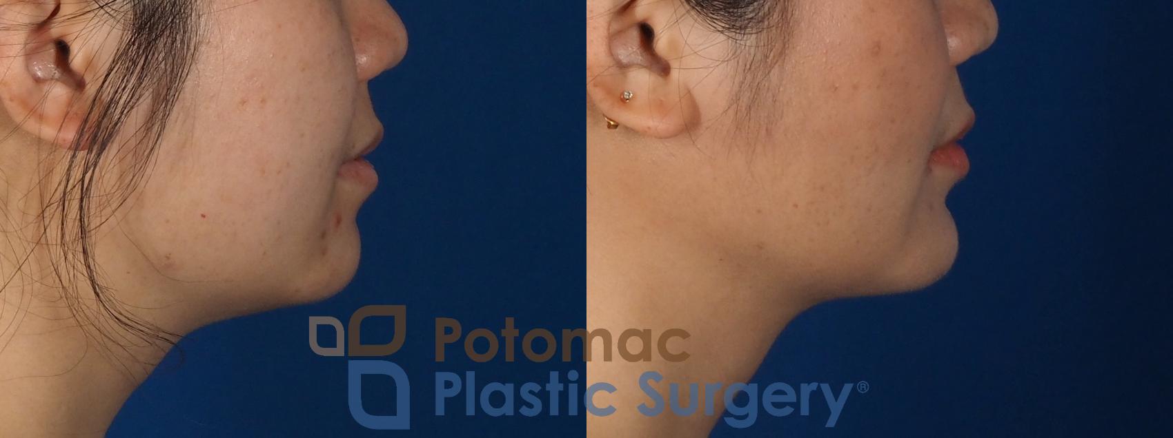 Before & After Facial Sculpting Case 359 Right Side View in Washington DC & Arlington , DC