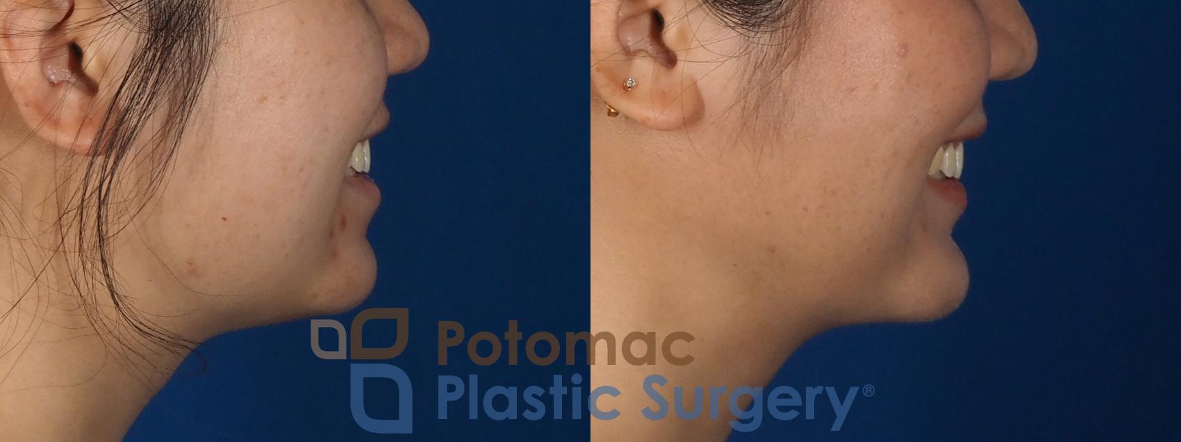 Before & After Facial Sculpting Case 359 Right - Smiling View in Washington DC & Arlington , DC