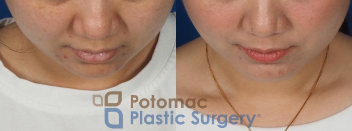 Before & After Facial Sculpting Case 359 Top View in Washington DC & Arlington , DC