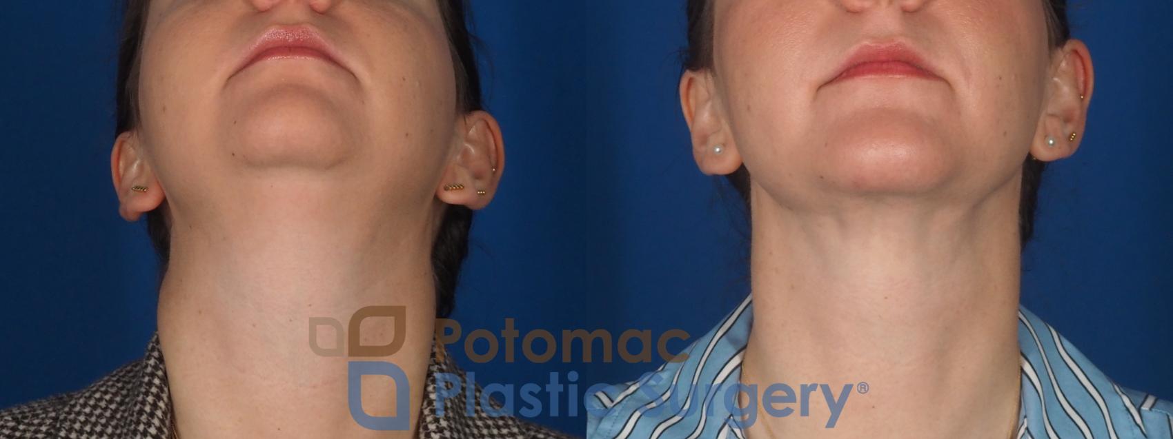 Before & After Facial Sculpting Case 360 Bottom View in Washington DC & Arlington , DC