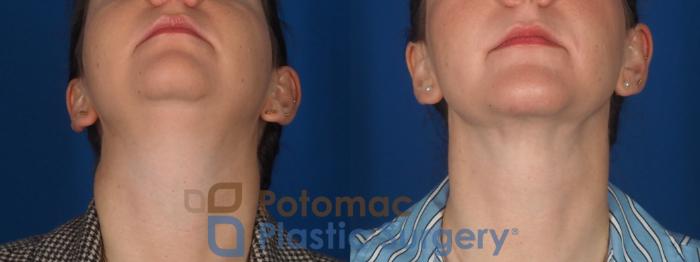 Before & After Facial Sculpting Case 360 Bottom View in Washington DC & Arlington , DC