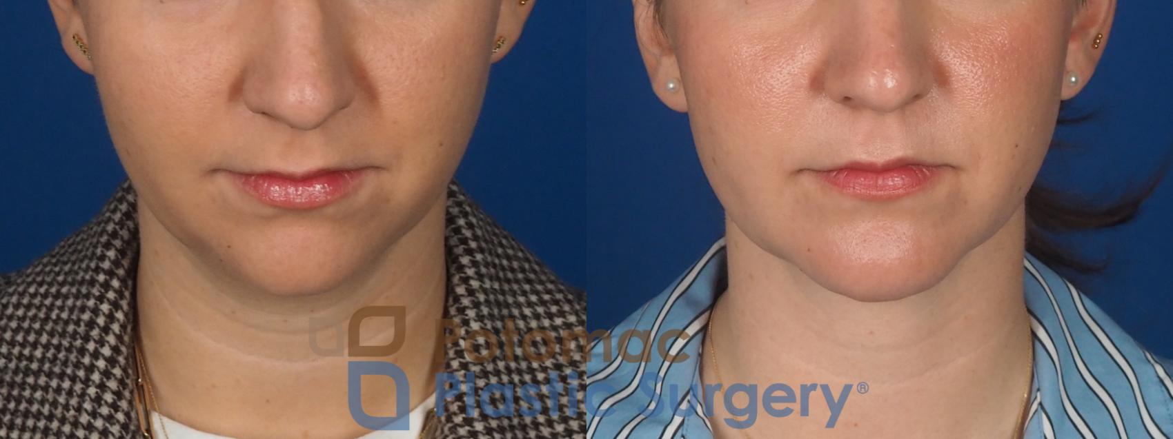 Before & After Facial Sculpting Case 360 Front View in Washington DC & Arlington , DC