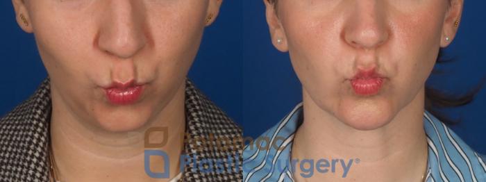 Before & After Facial Sculpting Case 360 Front - Puckering View in Washington DC & Arlington , DC