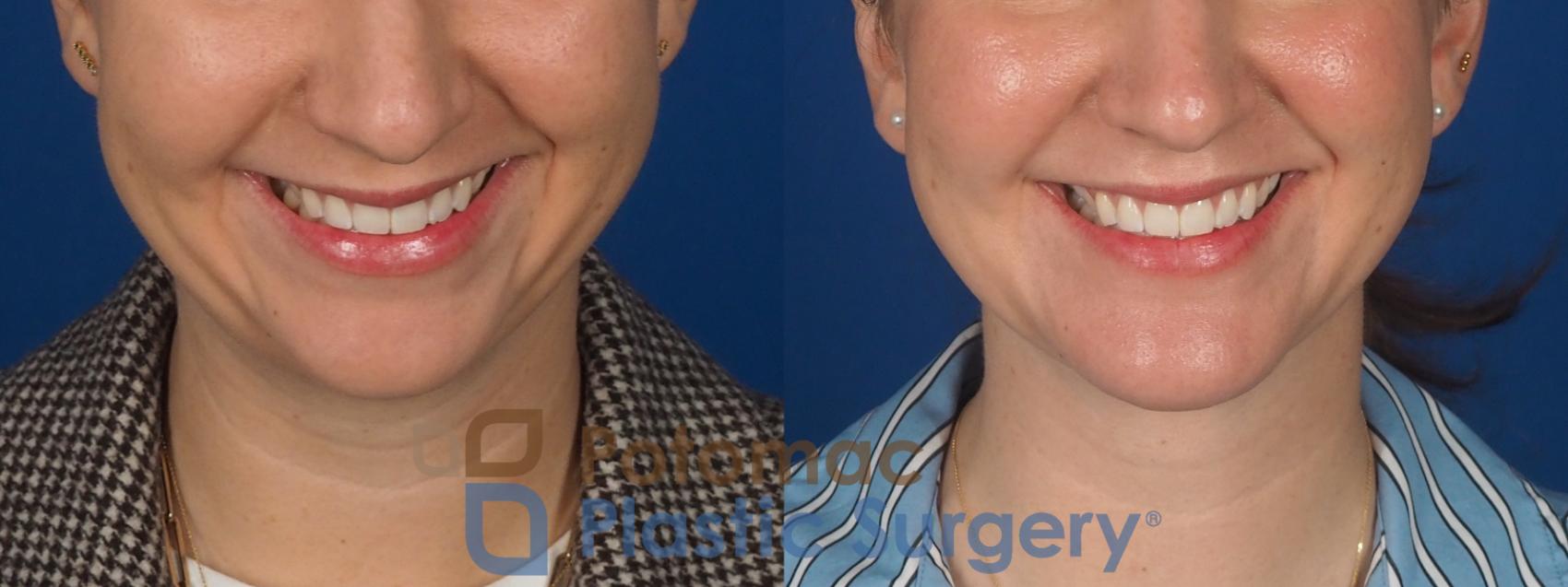 Before & After Facial Sculpting Case 360 Front - Smiling View in Washington DC & Arlington , DC