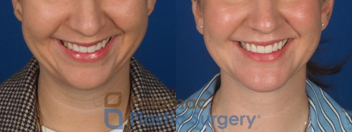 Before & After Facial Sculpting Case 360 Front - Smiling View in Washington DC & Arlington , DC