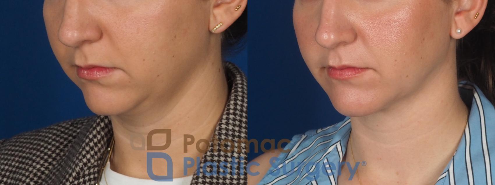 Before & After Facial Sculpting Case 360 Left Oblique View in Washington DC & Arlington , DC