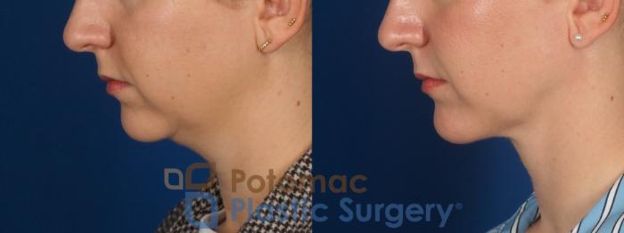 Before & After Facial Sculpting Case 360 Left Side View in Washington DC & Arlington , DC