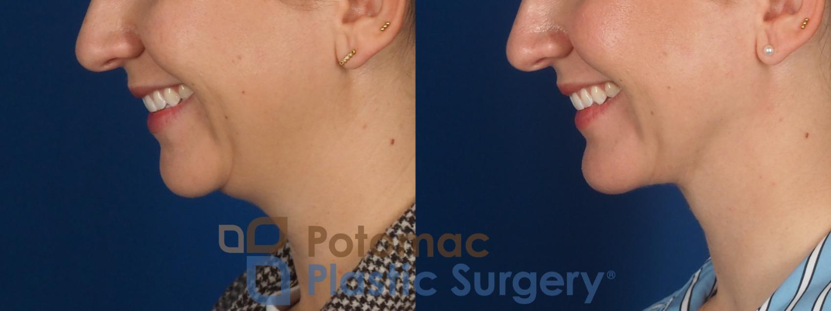 Before & After Facial Sculpting Case 360 Left - Smiling View in Washington DC & Arlington , DC