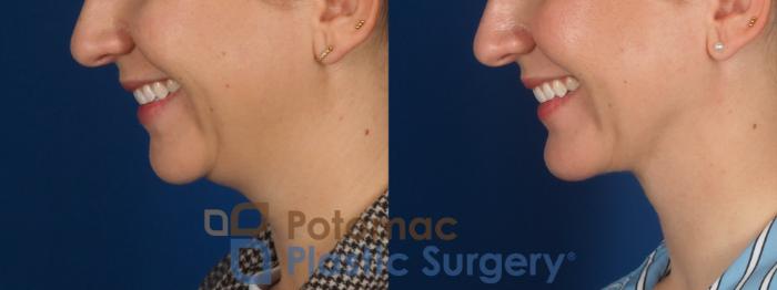 Before & After Facial Sculpting Case 360 Left - Smiling View in Washington DC & Arlington , DC