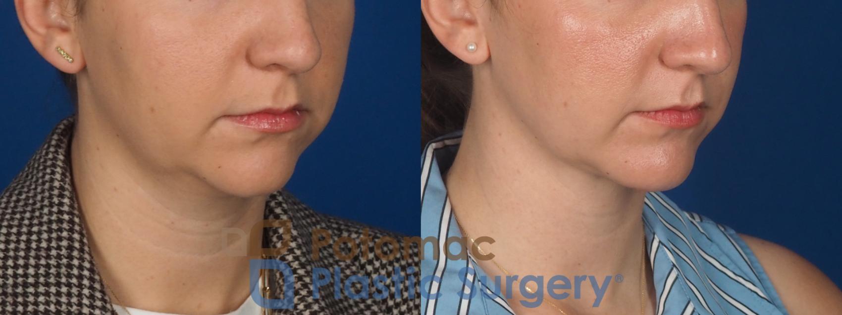Before & After Facial Sculpting Case 360 Right Oblique View in Washington DC & Arlington , DC