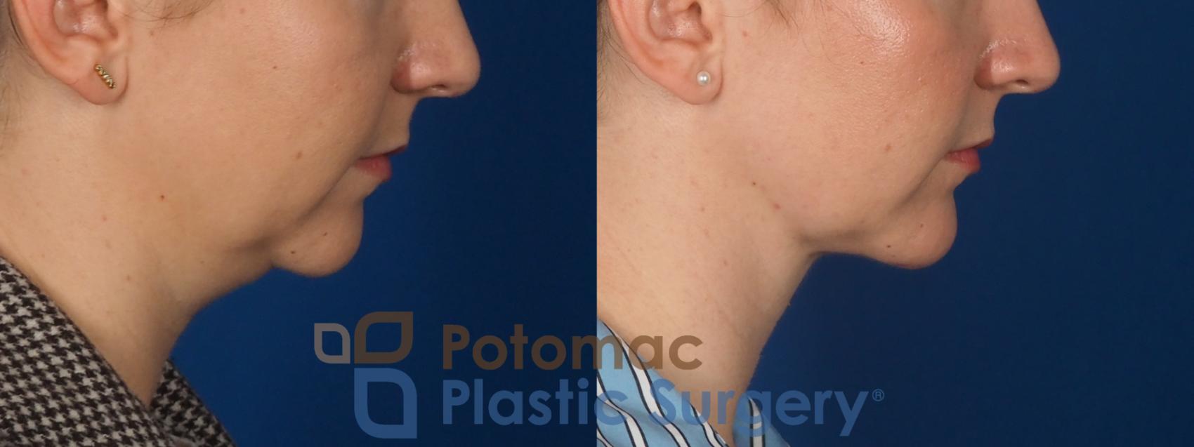 Before & After Facial Sculpting Case 360 Right Side View in Washington DC & Arlington , DC