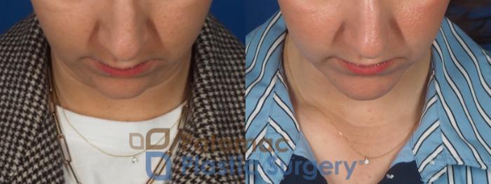Before & After Facial Sculpting Case 360 Top View in Washington DC & Arlington , DC