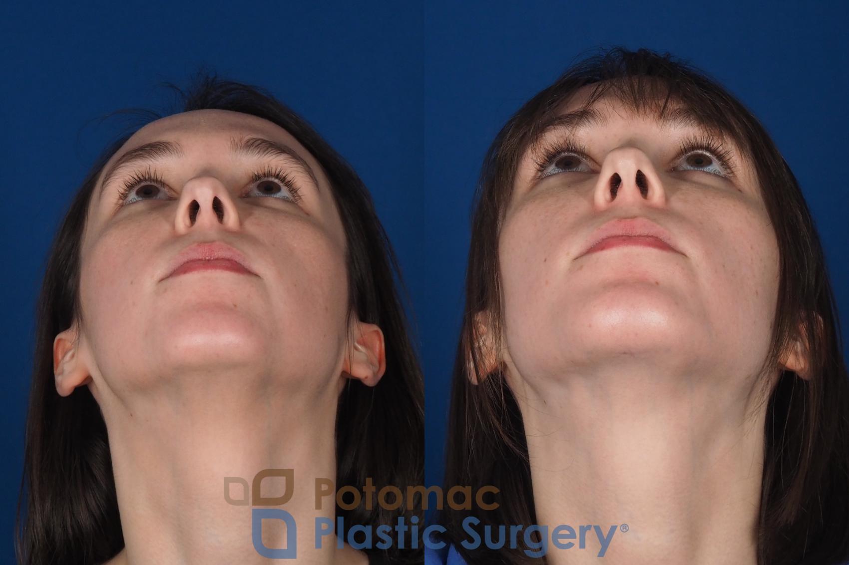 Before & After Facial Sculpting Case 361 Bottom View in Washington DC & Arlington , DC