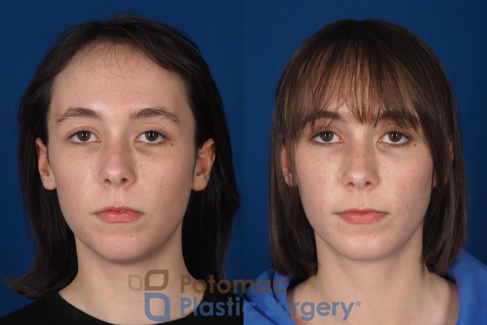 Before & After Facial Sculpting Case 361 Front View in Washington DC & Arlington , DC