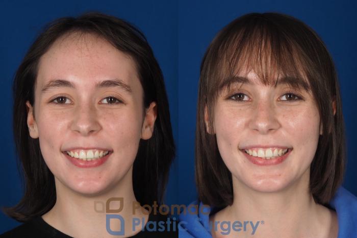 Before & After Facial Sculpting Case 361 Front - Smiling View in Washington DC & Arlington , DC