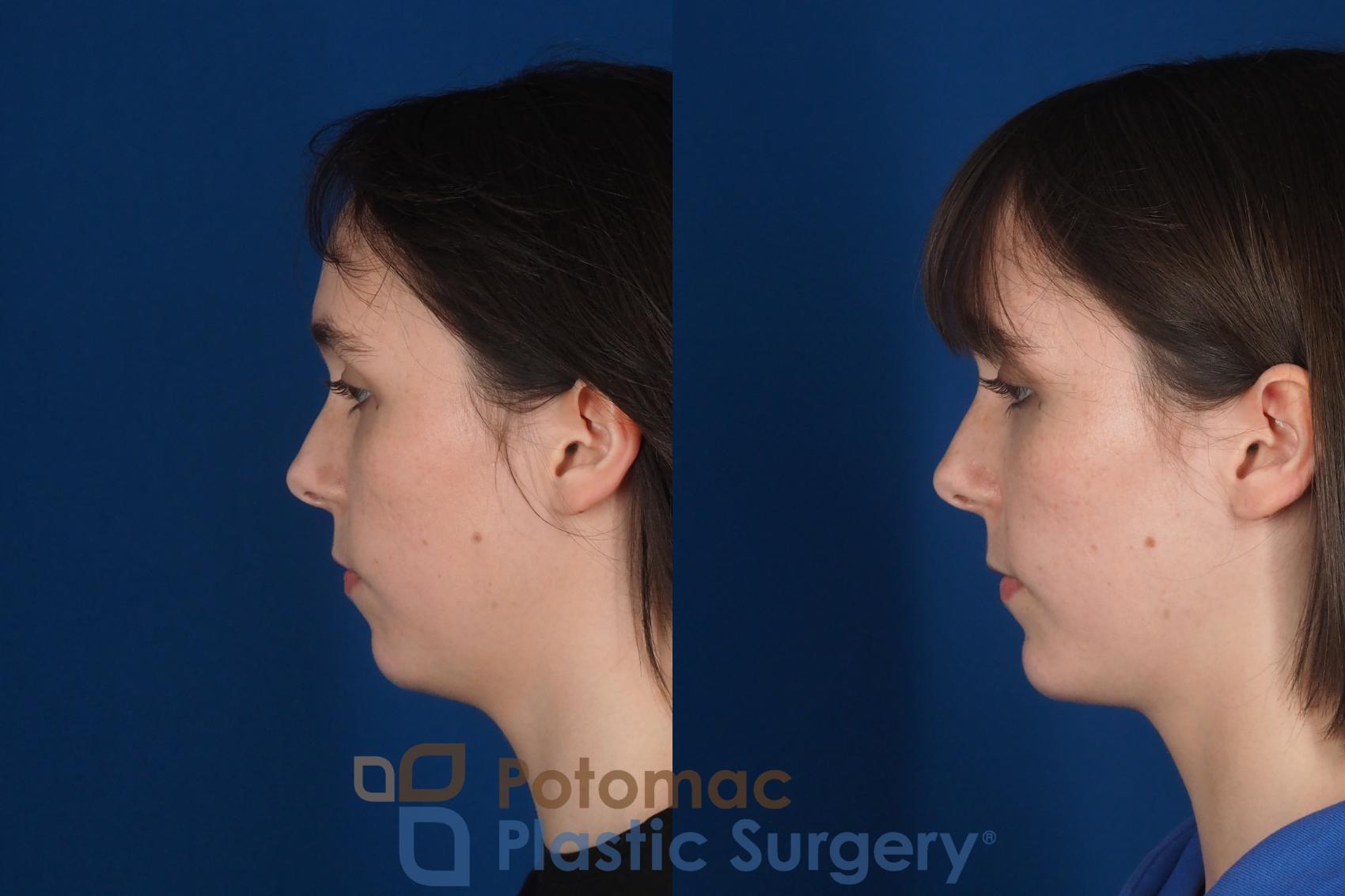 Before & After Facial Sculpting Case 361 Left View in Washington DC & Arlington , DC