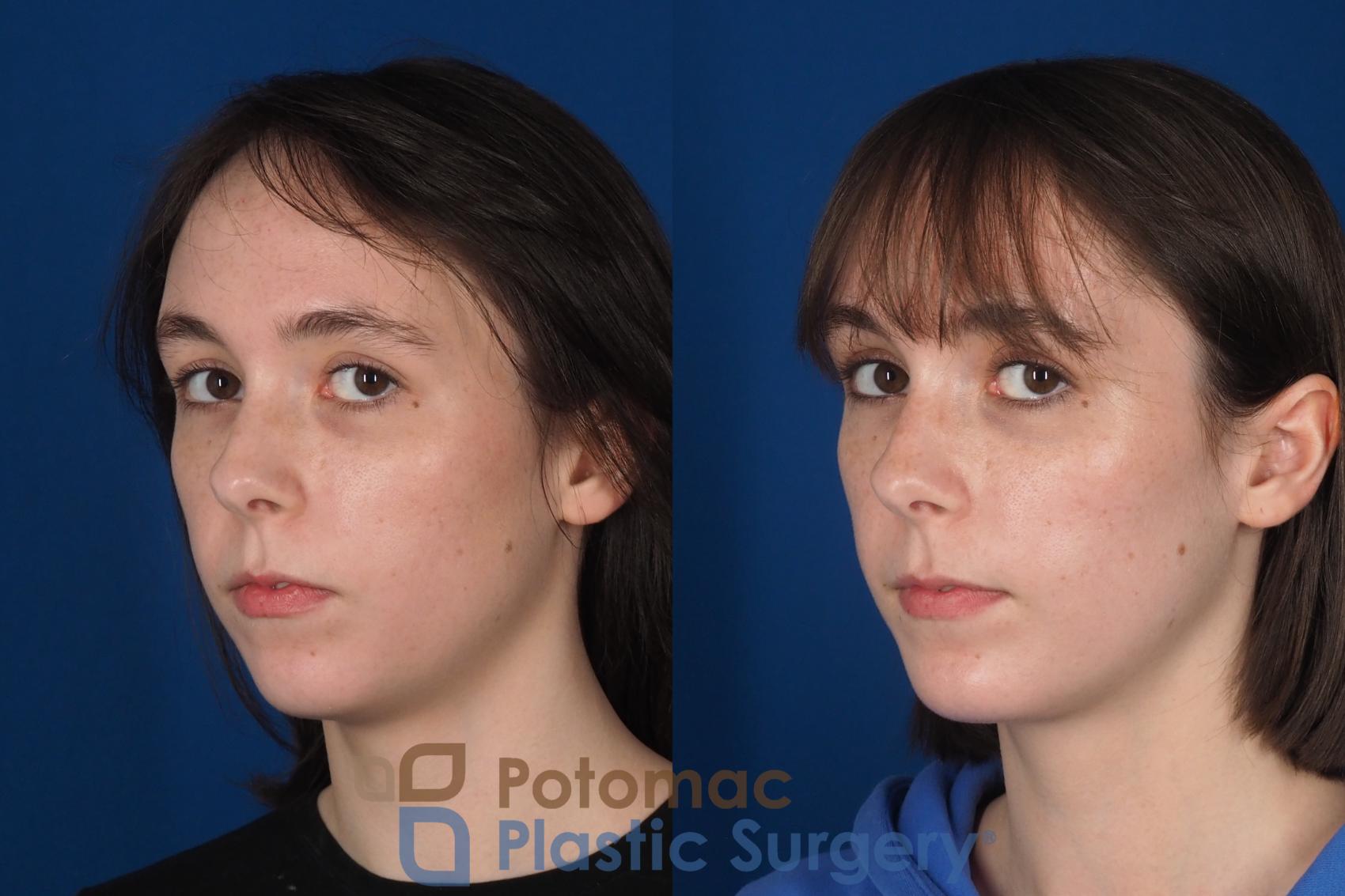 Before & After Facial Sculpting Case 361 Left Oblique 2 View in Washington DC & Arlington , DC