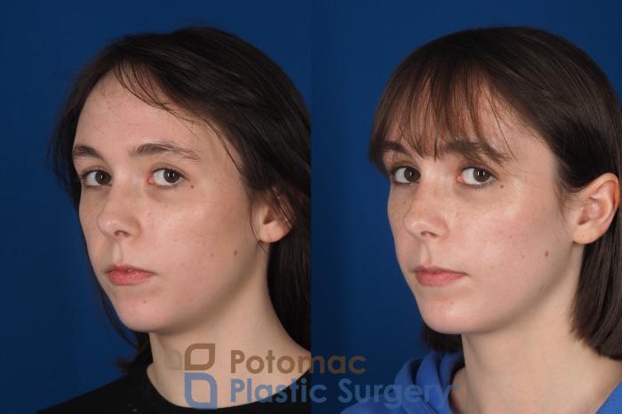 Before & After Facial Sculpting Case 361 Left Oblique 2 View in Washington DC & Arlington , DC