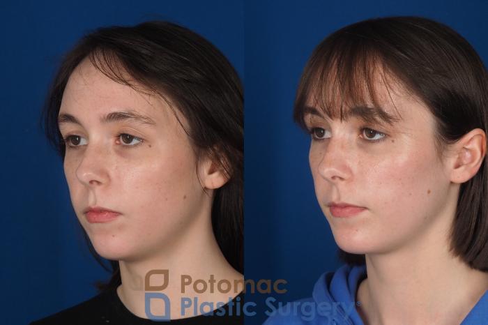 Before & After Facial Sculpting Case 361 Left Oblique View in Washington DC & Arlington , DC