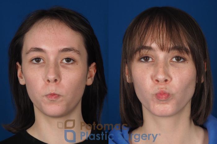 Before & After Facial Sculpting Case 361 Left Side View in Washington DC & Arlington , DC