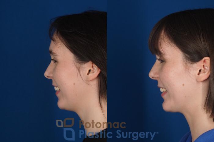 Before & After Facial Sculpting Case 361 Left - Smiling View in Washington DC & Arlington , DC