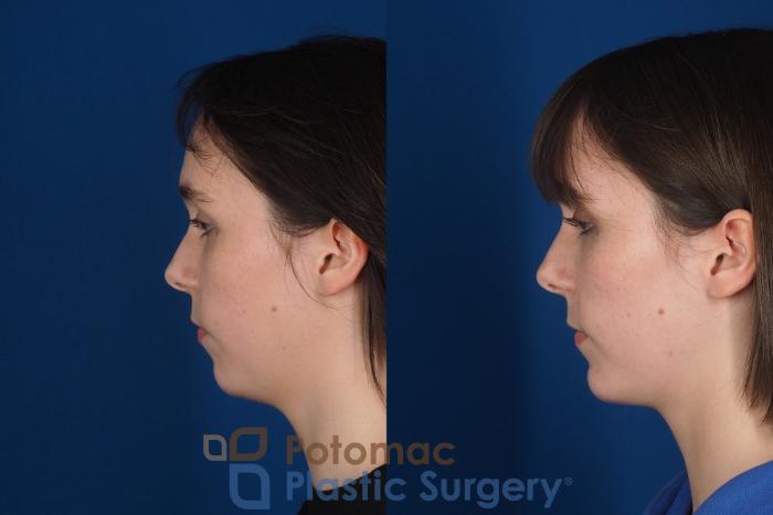 Before & After Facial Sculpting Case 361 Left View in Washington DC & Arlington , DC