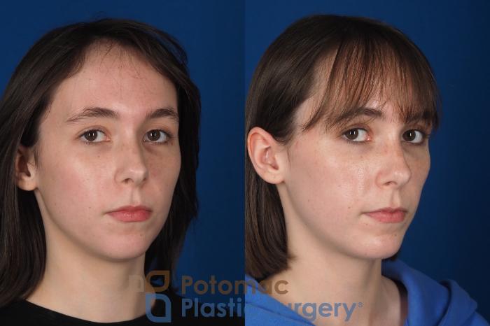 Before & After Facial Sculpting Case 361 Right Oblique 2 View in Washington DC & Arlington , DC