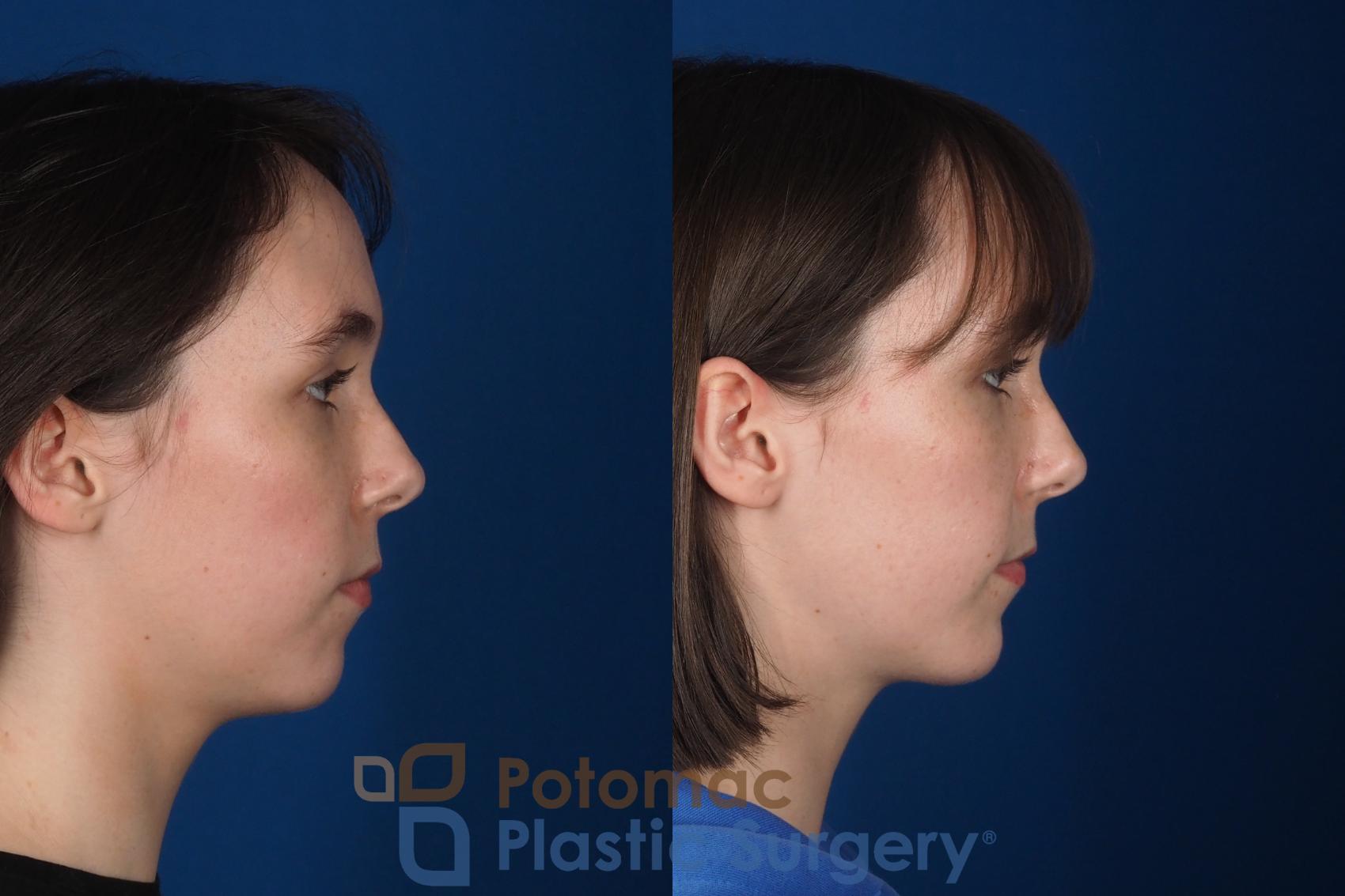 Before & After Facial Sculpting Case 361 Right Side View in Washington DC & Arlington , DC