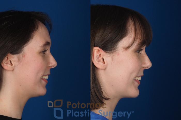 Before & After Facial Sculpting Case 361 Right - Smiling View in Washington DC & Arlington , DC
