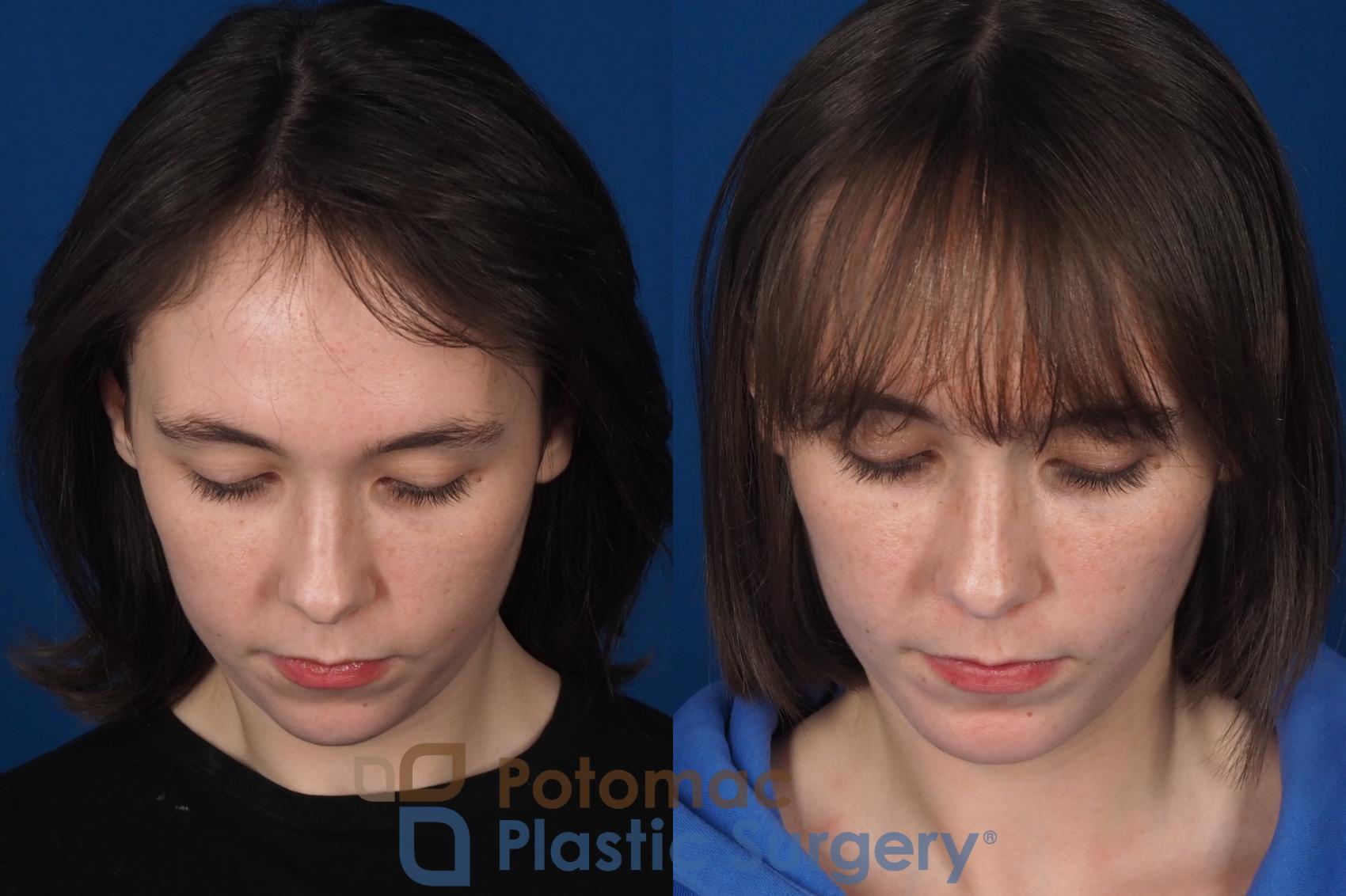 Before & After Facial Sculpting Case 361 Top View in Washington DC & Arlington , DC
