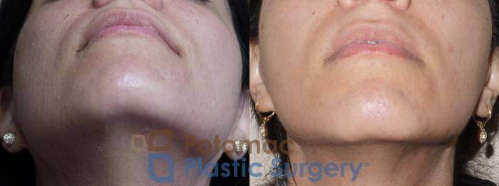 Before & After Botox Cosmetic Case 40 Bottom View in Washington DC & Arlington , DC