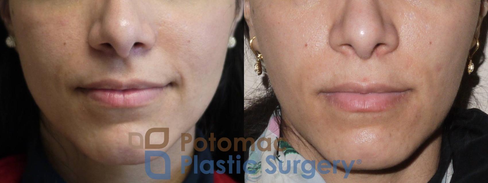 Before & After Facial Sculpting Case 40 Front View in Washington DC & Arlington , DC
