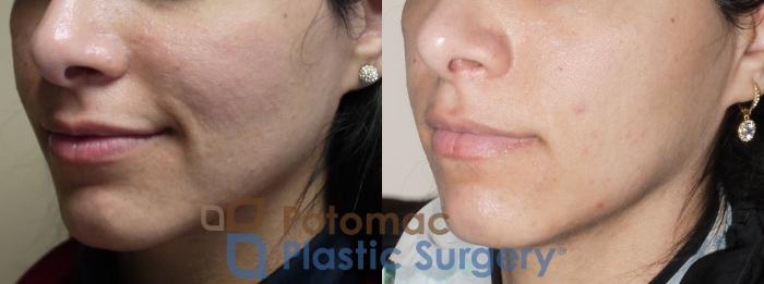 Before & After Botox Cosmetic Case 40 Left Oblique View in Washington DC & Arlington , DC